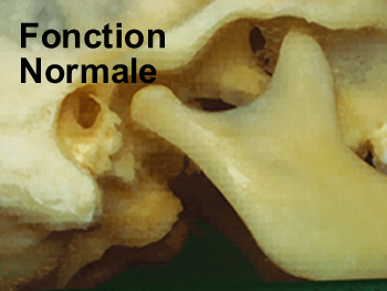 articulation mandibule crne A T M , sans acouphne